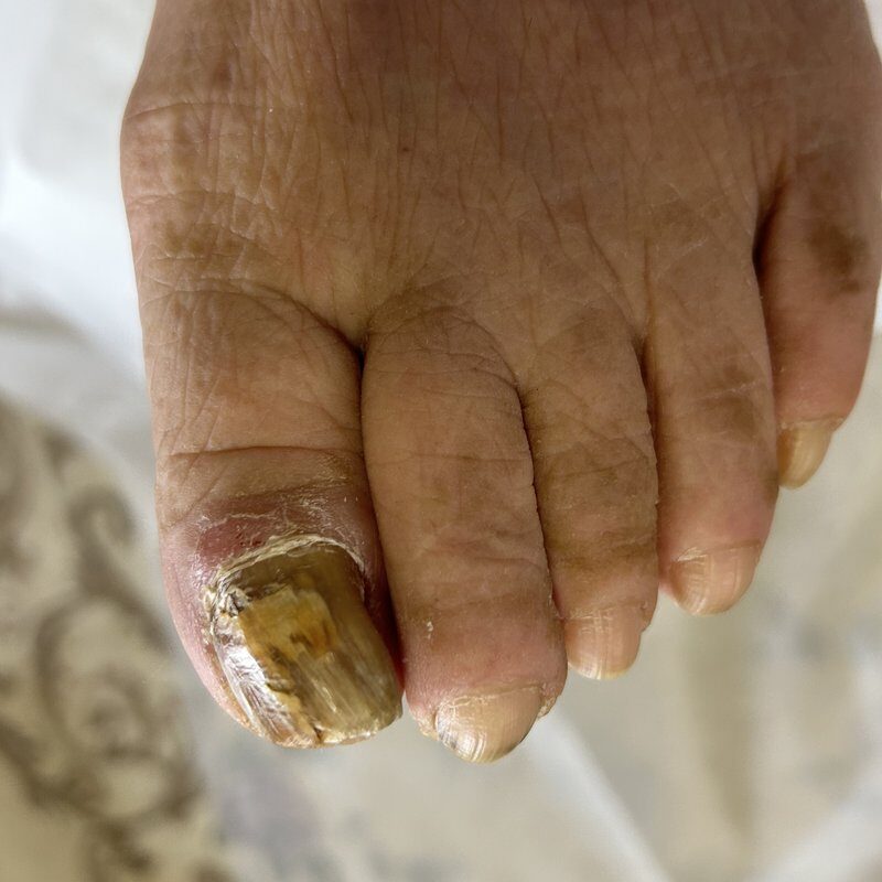 矢田昌子さんの足のケア前（2023年6月）