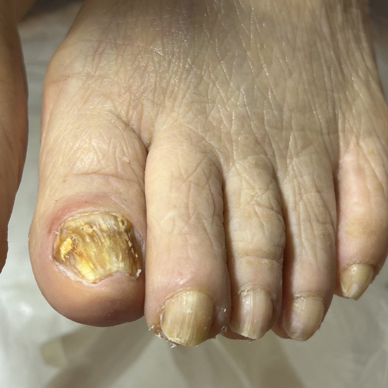 矢田昌子さんの足のケア後（2026年4月）